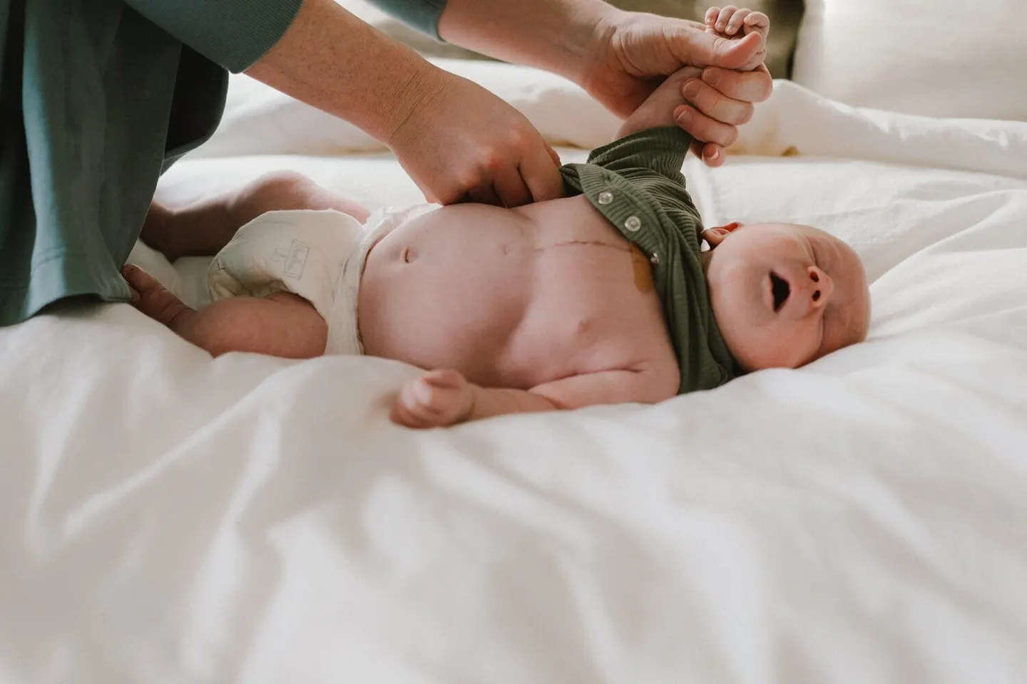 Overhead shot of a newborn's cesarean scar as a parent buttons a green onesie